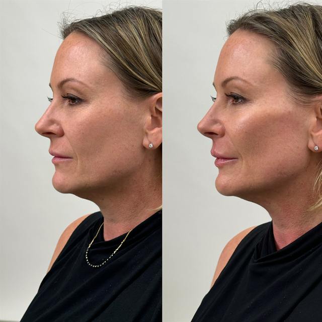Unretouched before and after result, the drBand Clinic