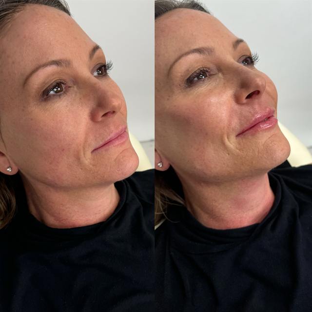 Unretouched before and after result, the drBand Clinic