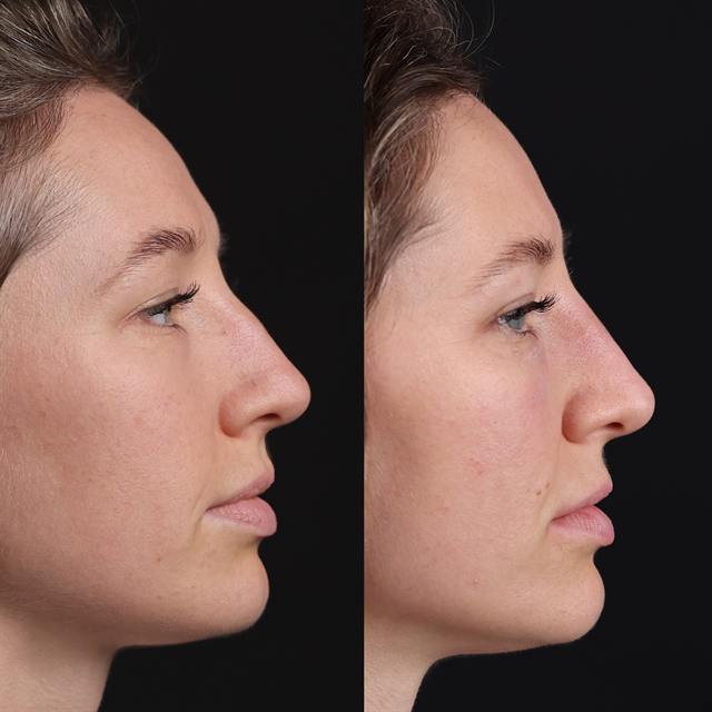 Unretouched before and after result, the drBand Clinic