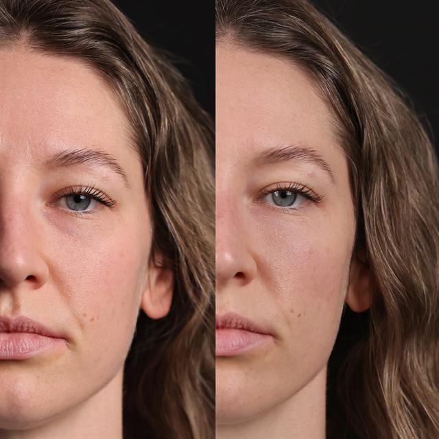 Unretouched before and after result, the drBand Clinic