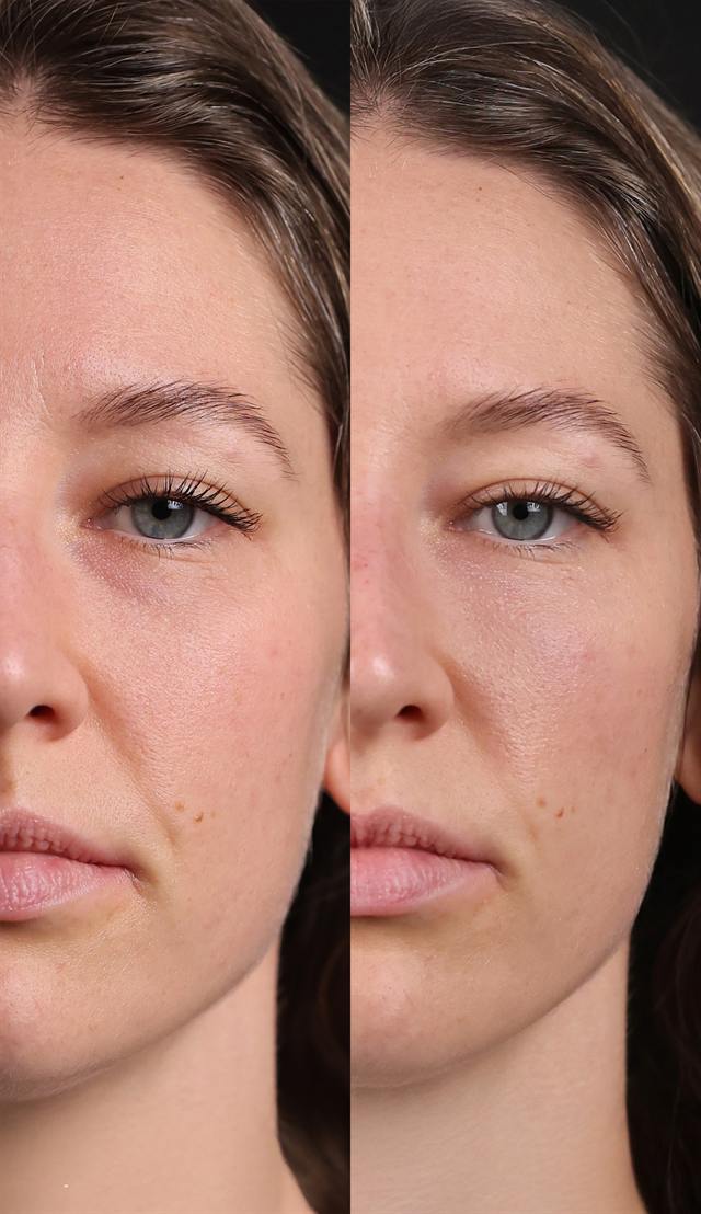Unretouched before and after result, the drBand Clinic