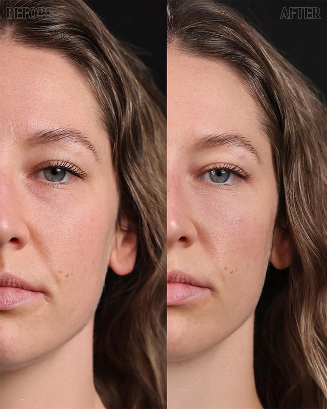 Unretouched before and after result, the drBand Clinic