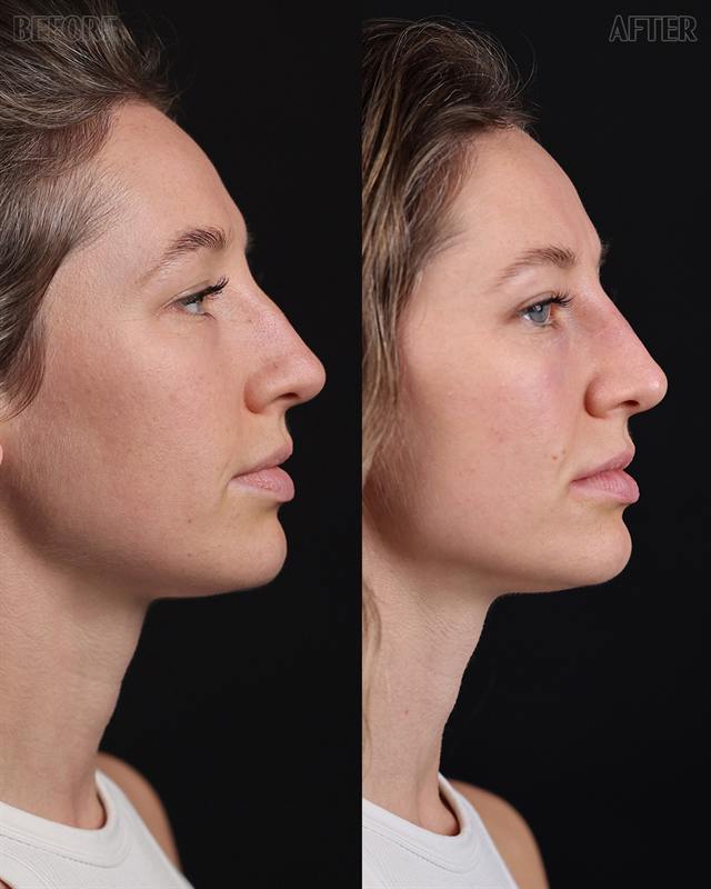 Unretouched before and after result, the drBand Clinic