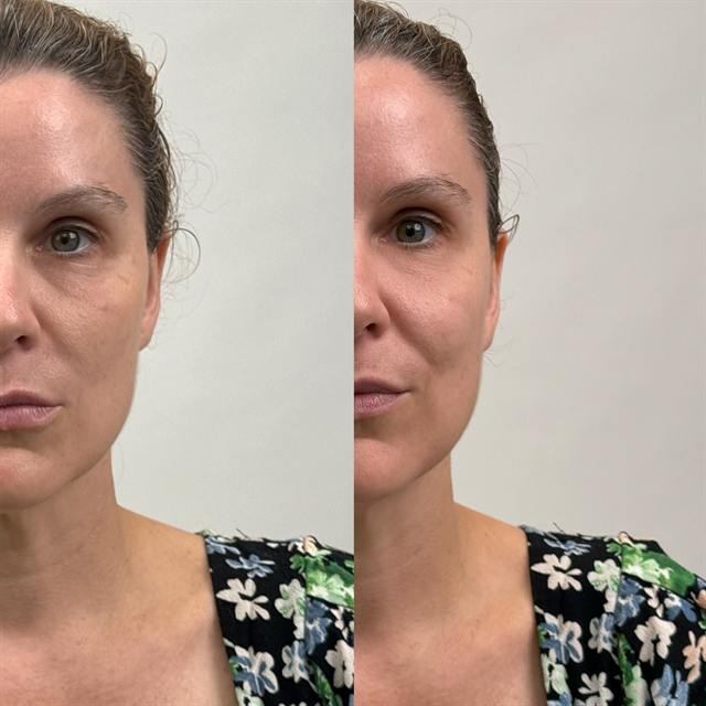 Unretouched before and after result, the drBand Clinic