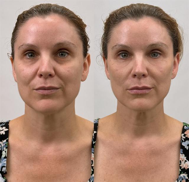 Unretouched before and after result, the drBand Clinic