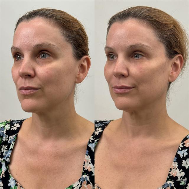 Unretouched before and after result, the drBand Clinic