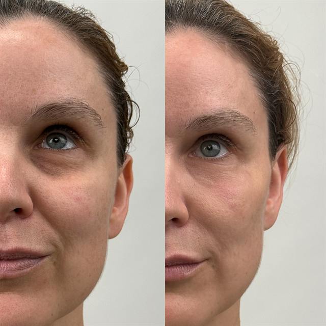 Unretouched before and after result, the drBand Clinic