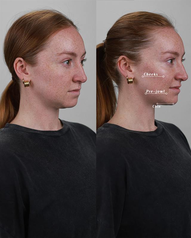 Unretouched before and after result, the drBand Clinic