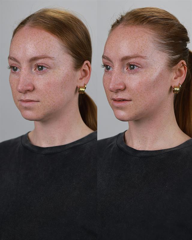 Unretouched before and after result, the drBand Clinic