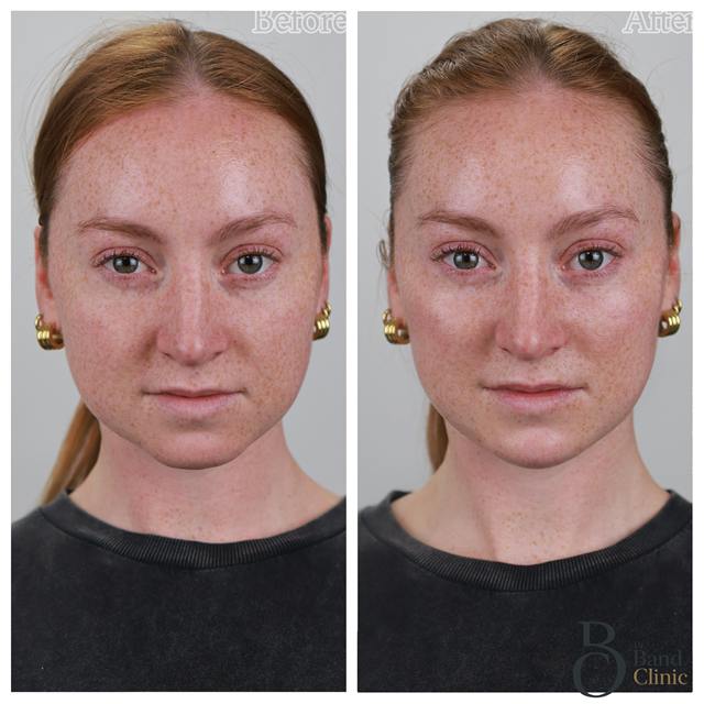 Unretouched before and after result, the drBand Clinic