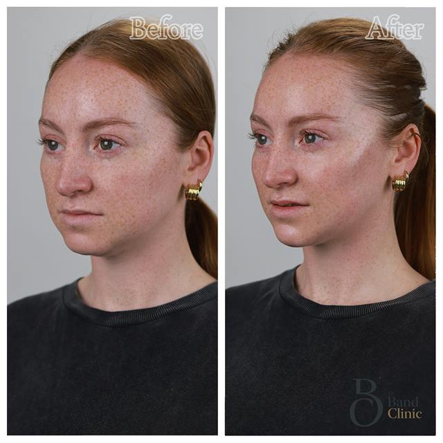 Unretouched before and after result, the drBand Clinic