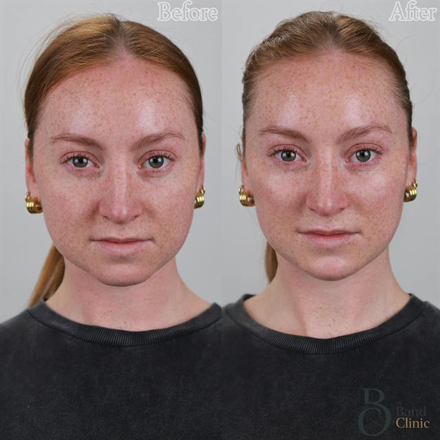 Unretouched before and after result, the drBand Clinic