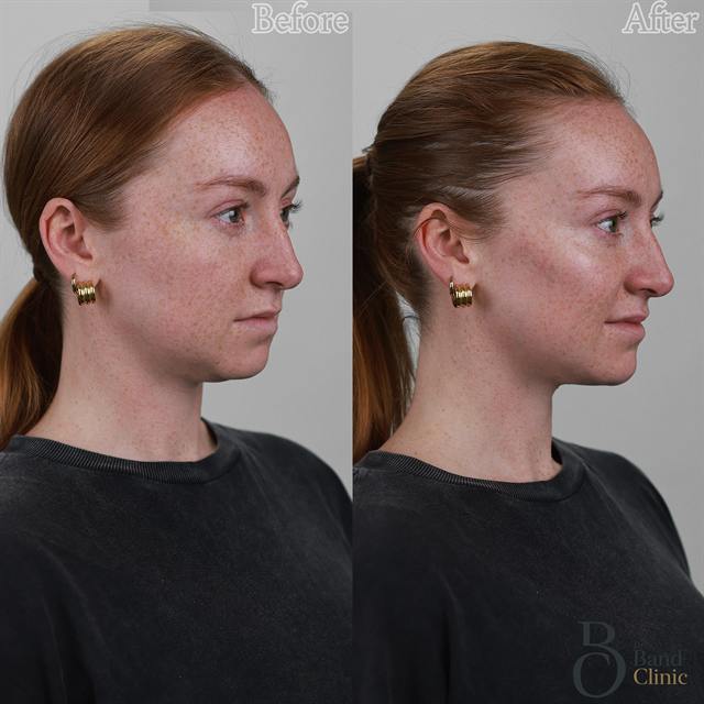Unretouched before and after result, the drBand Clinic