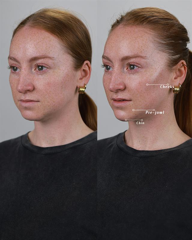 Unretouched before and after result, the drBand Clinic