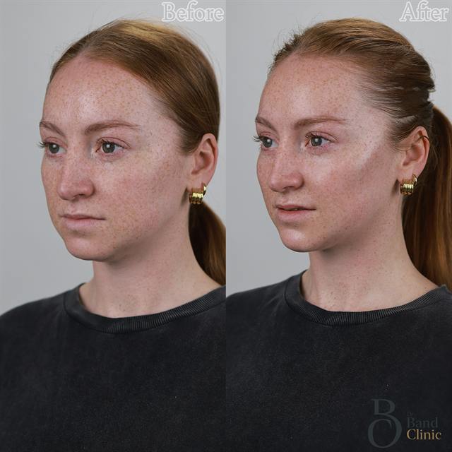 Unretouched before and after result, the drBand Clinic