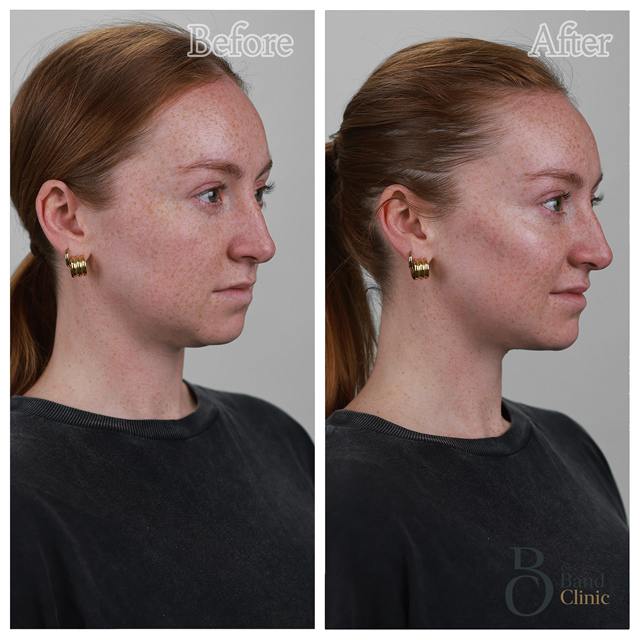 Unretouched before and after result, the drBand Clinic