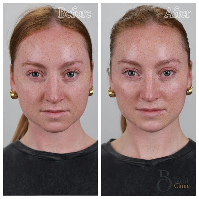 Unretouched before and after result, the drBand Clinic
