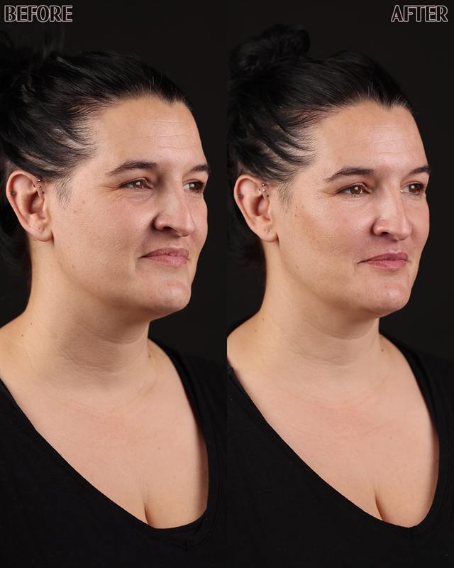 Unretouched before and after result, the drBand Clinic