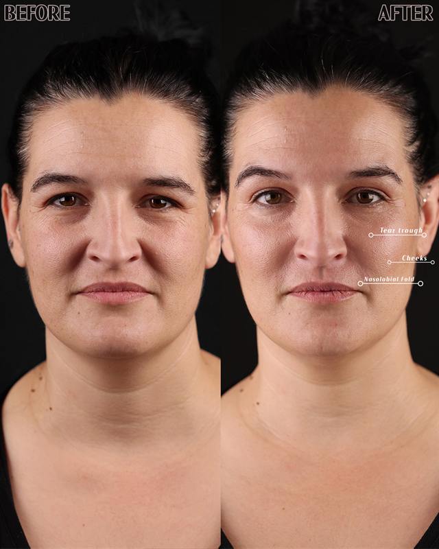 Unretouched before and after result, the drBand Clinic