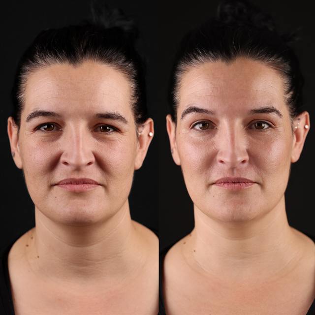 Unretouched before and after result, the drBand Clinic