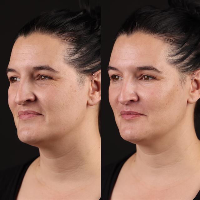 Unretouched before and after result, the drBand Clinic