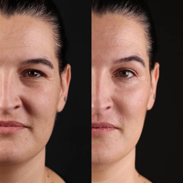 Unretouched before and after result, the drBand Clinic