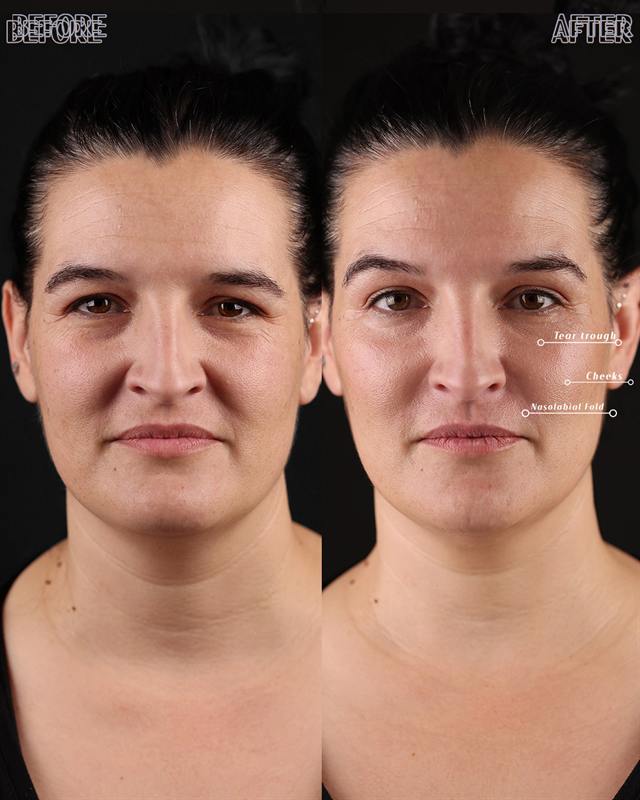 Unretouched before and after result, the drBand Clinic