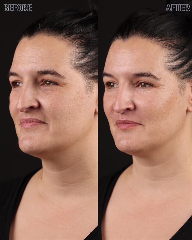 Unretouched before and after result, the drBand Clinic