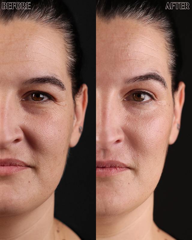 Unretouched before and after result, the drBand Clinic
