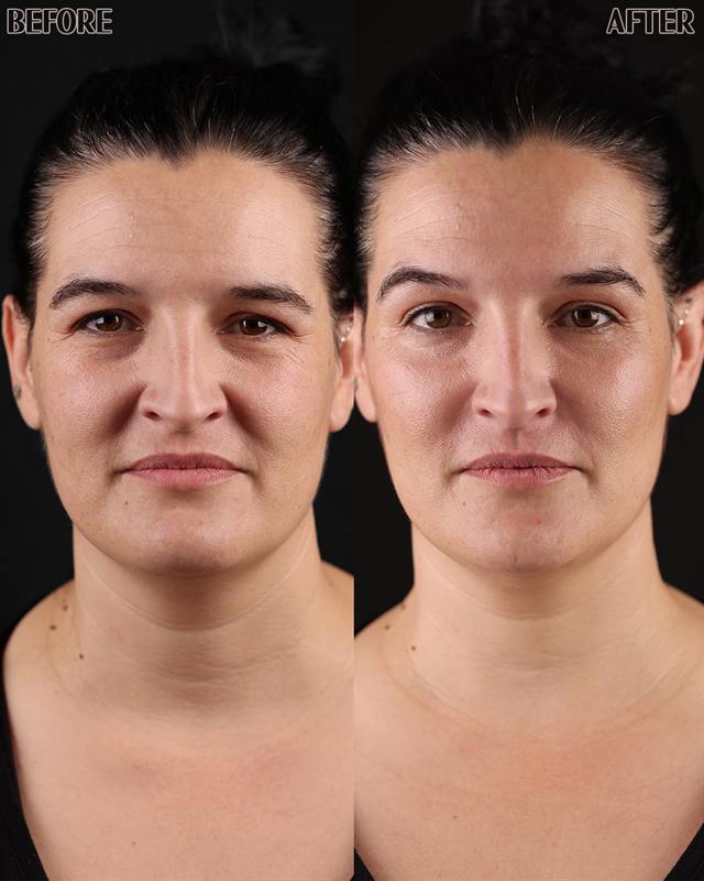 Unretouched before and after result, the drBand Clinic