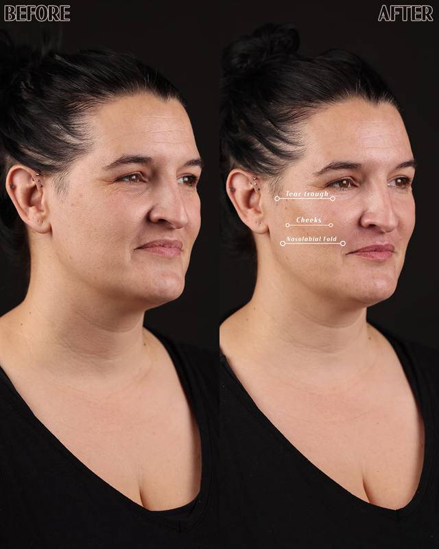 Unretouched before and after result, the drBand Clinic