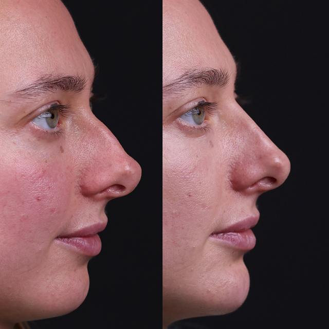 Unretouched before and after result, the drBand Clinic