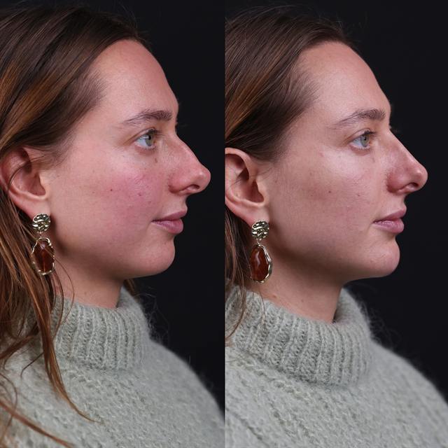 Unretouched before and after result, the drBand Clinic