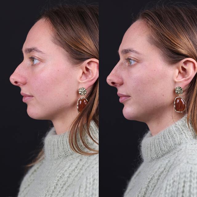Unretouched before and after result, the drBand Clinic
