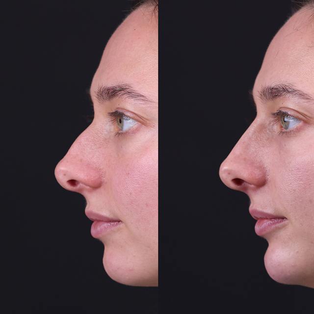 Unretouched before and after result, the drBand Clinic