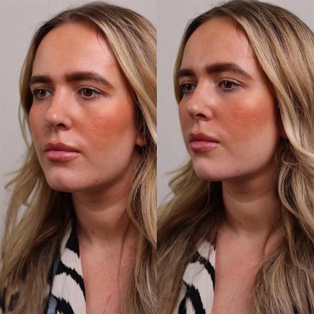 Unretouched before and after result, the drBand Clinic