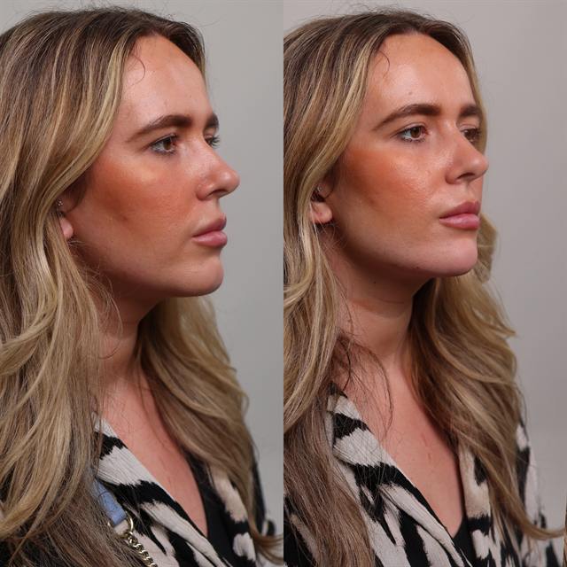Unretouched before and after result, the drBand Clinic