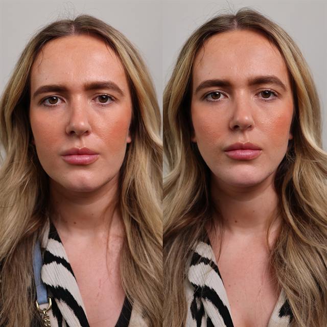 Unretouched before and after result, the drBand Clinic