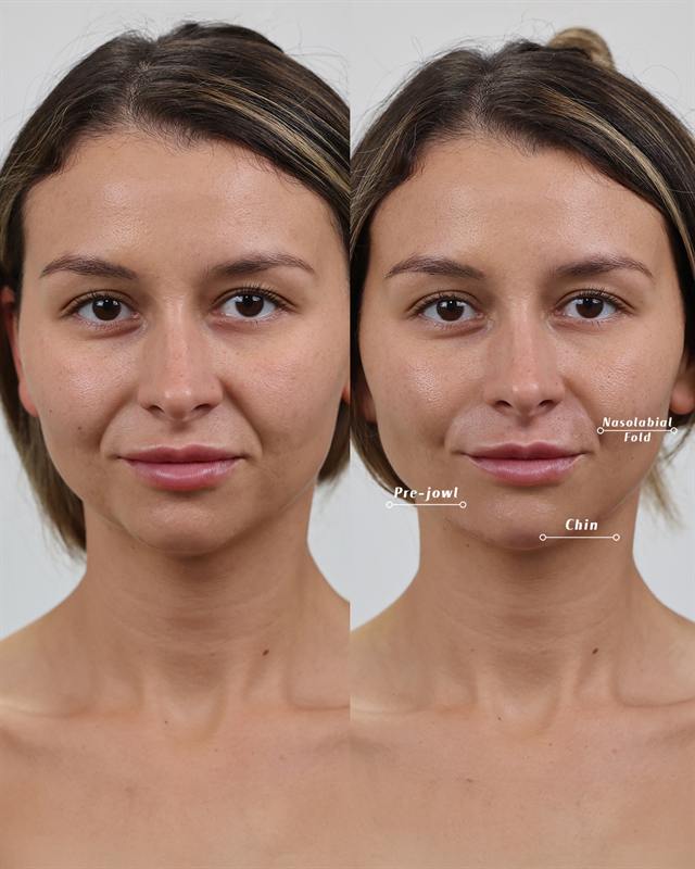 Unretouched before and after result, the drBand Clinic