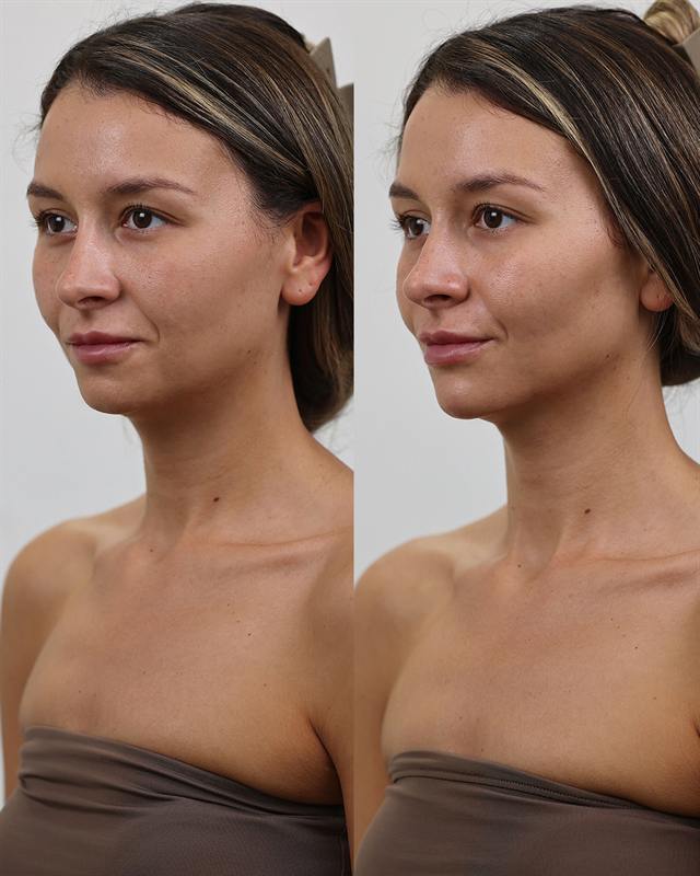 Unretouched before and after result, the drBand Clinic