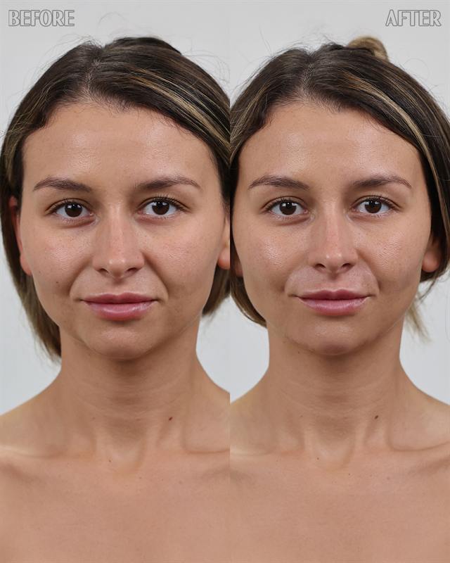 Unretouched before and after result, the drBand Clinic