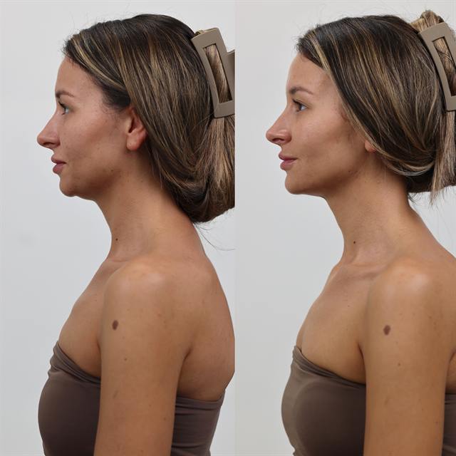 Unretouched before and after result, the drBand Clinic