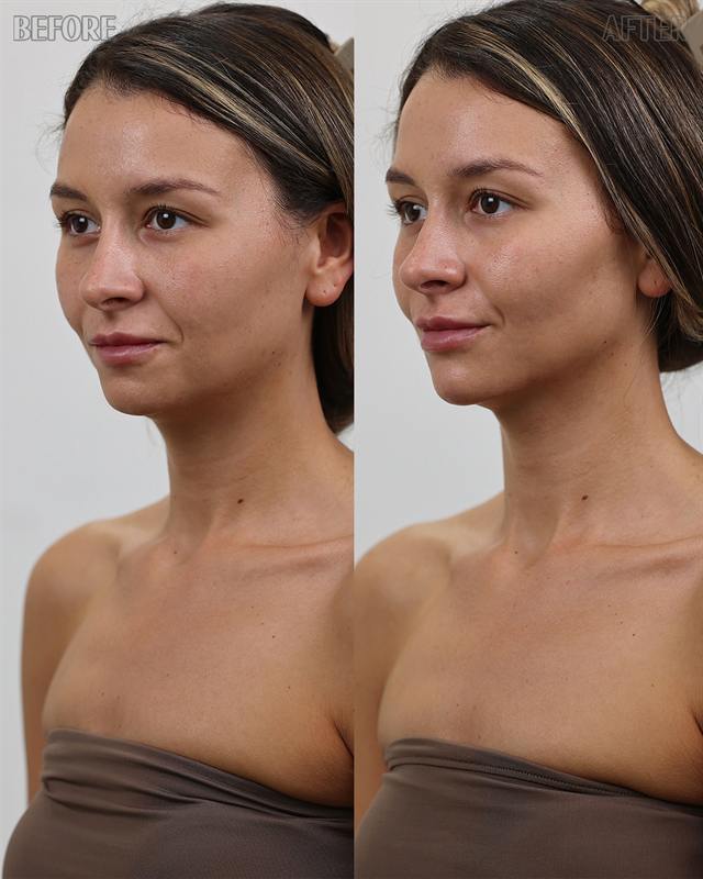 Unretouched before and after result, the drBand Clinic