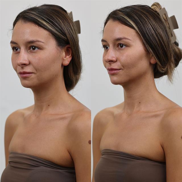 Unretouched before and after result, the drBand Clinic