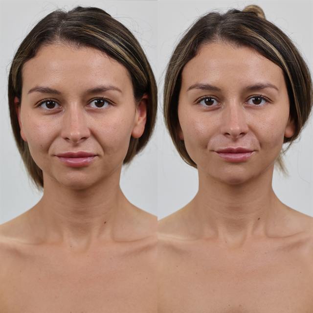 Unretouched before and after result, the drBand Clinic