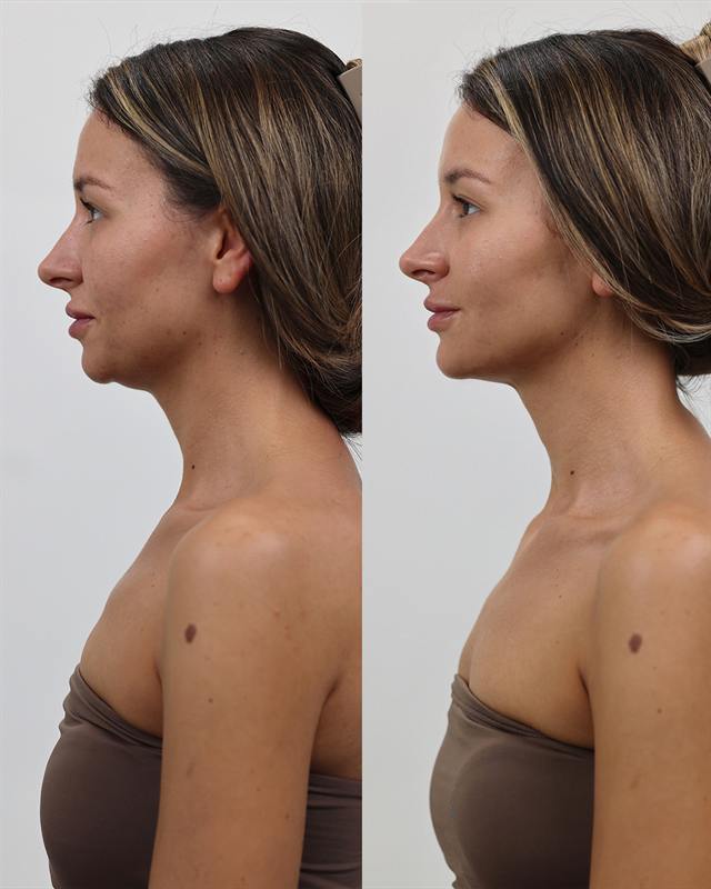 Unretouched before and after result, the drBand Clinic
