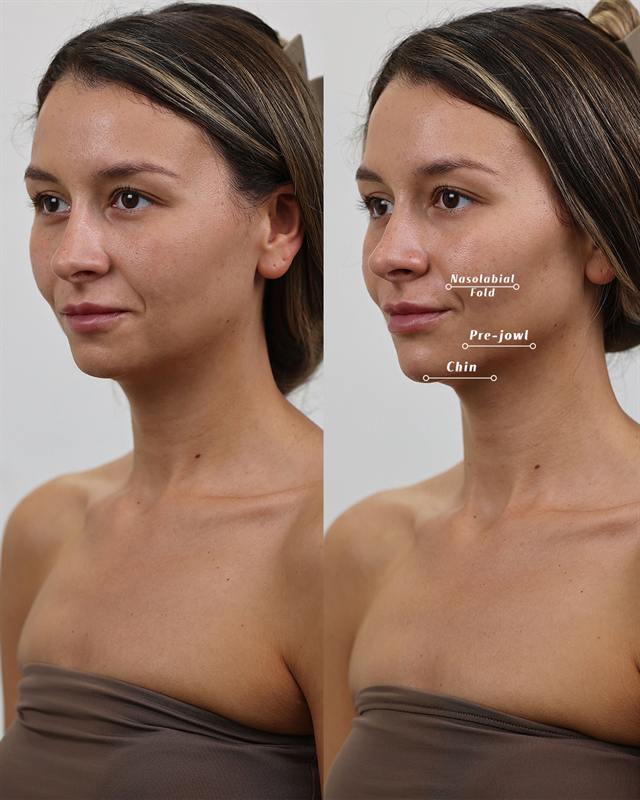 Unretouched before and after result, the drBand Clinic