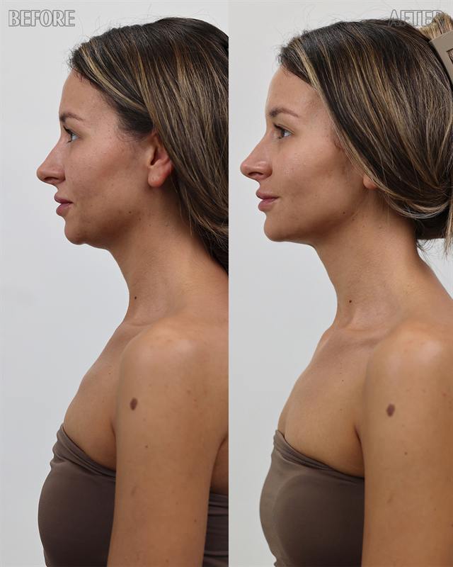 Unretouched before and after result, the drBand Clinic
