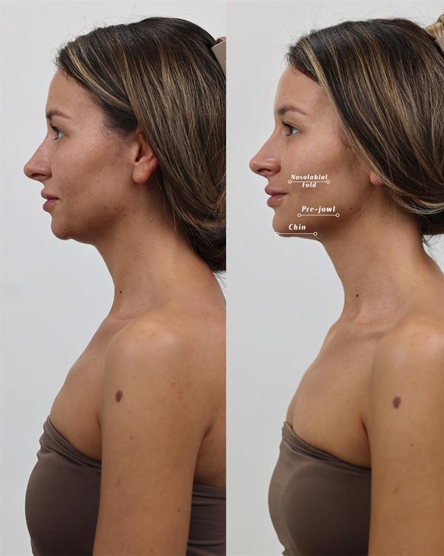 Unretouched before and after result, the drBand Clinic