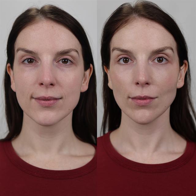 Unretouched before and after result, the drBand Clinic